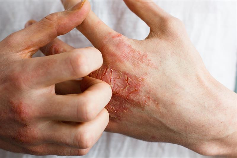 Psoriasis